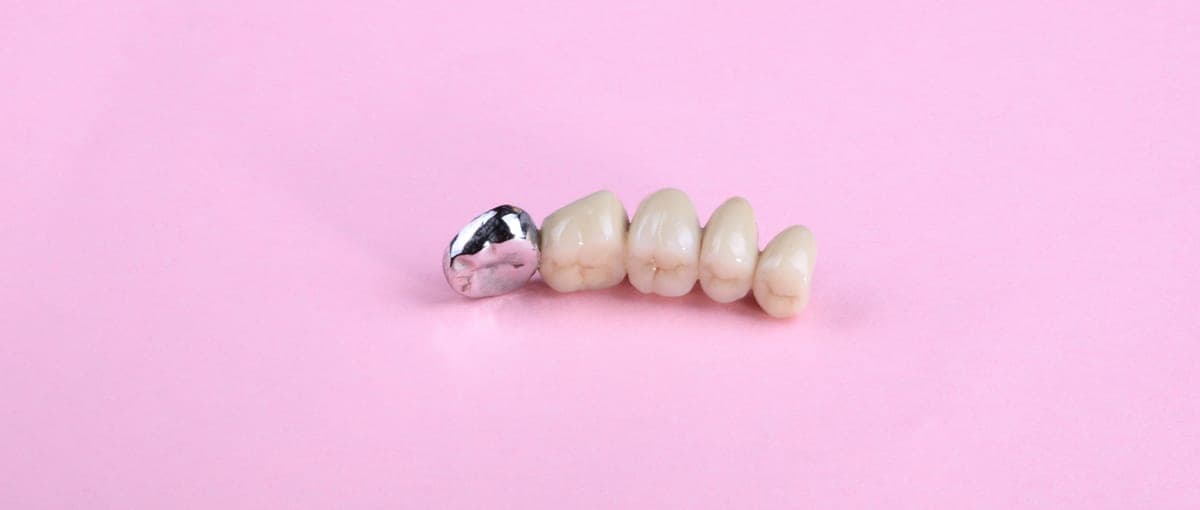 Porcelain Fused to Metal